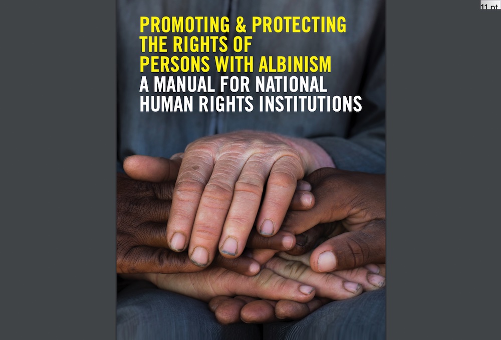 Les albinos: « Les droits de l’homme sont aussi valables pour eux !!! »